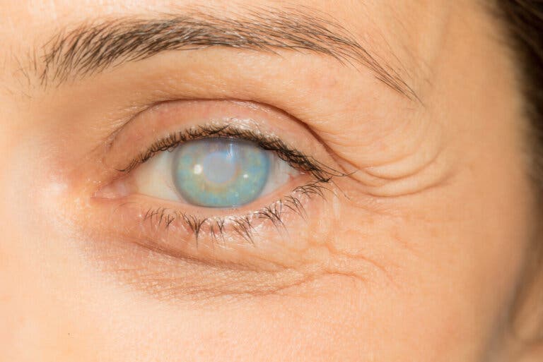 ¿Cuáles son los síntomas de la oncocercosis?