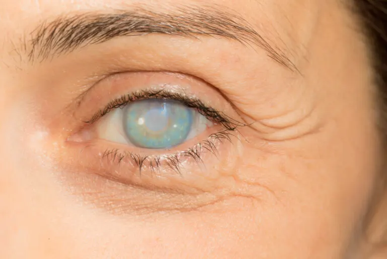 ¿Cuáles son los síntomas de la oncocercosis?
