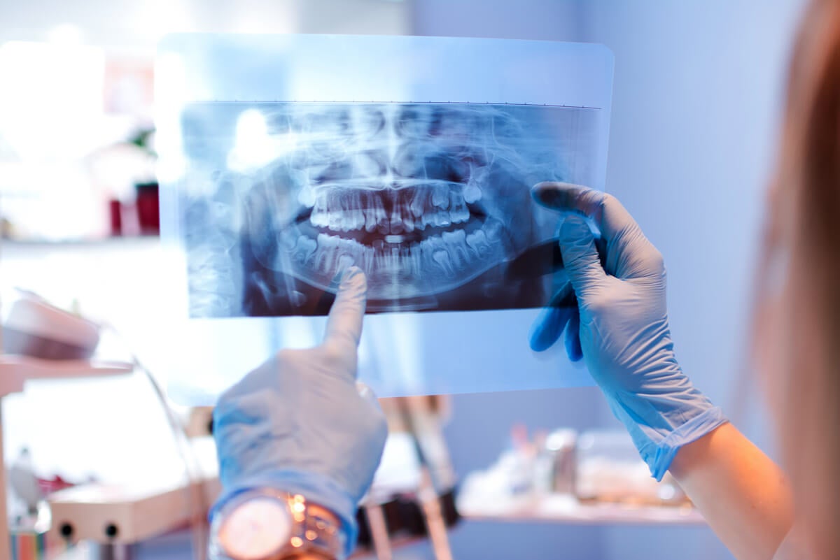 Ortopantomografía para planificar una prótesis sobre implantes dentales.