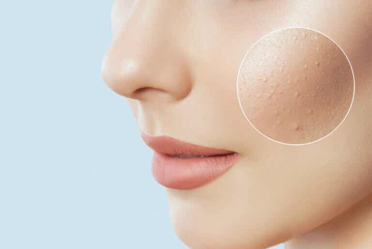 Beneficios del ácido azelaico para la piel