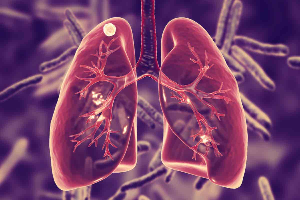 Tuberculosis pulmonar que necesita lobectomía.