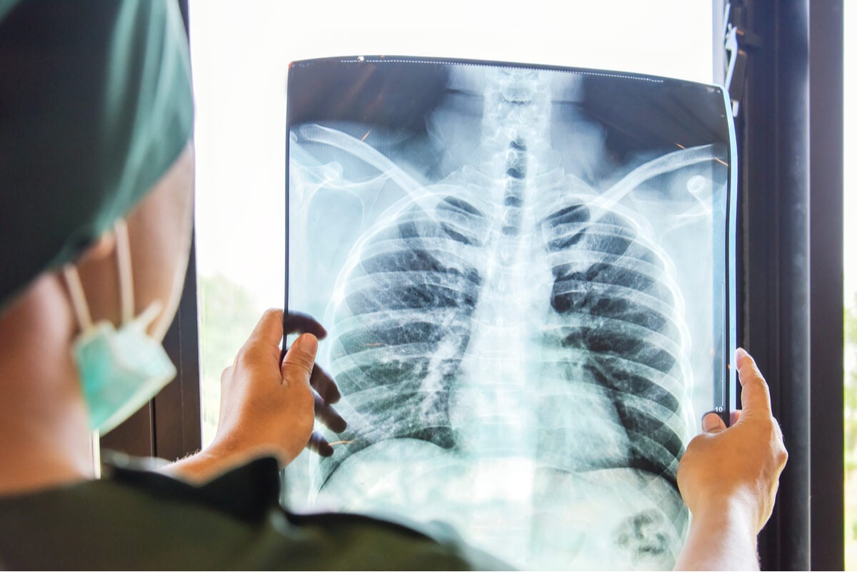 Mesotelioma causa mancha en radiografía de tórax.