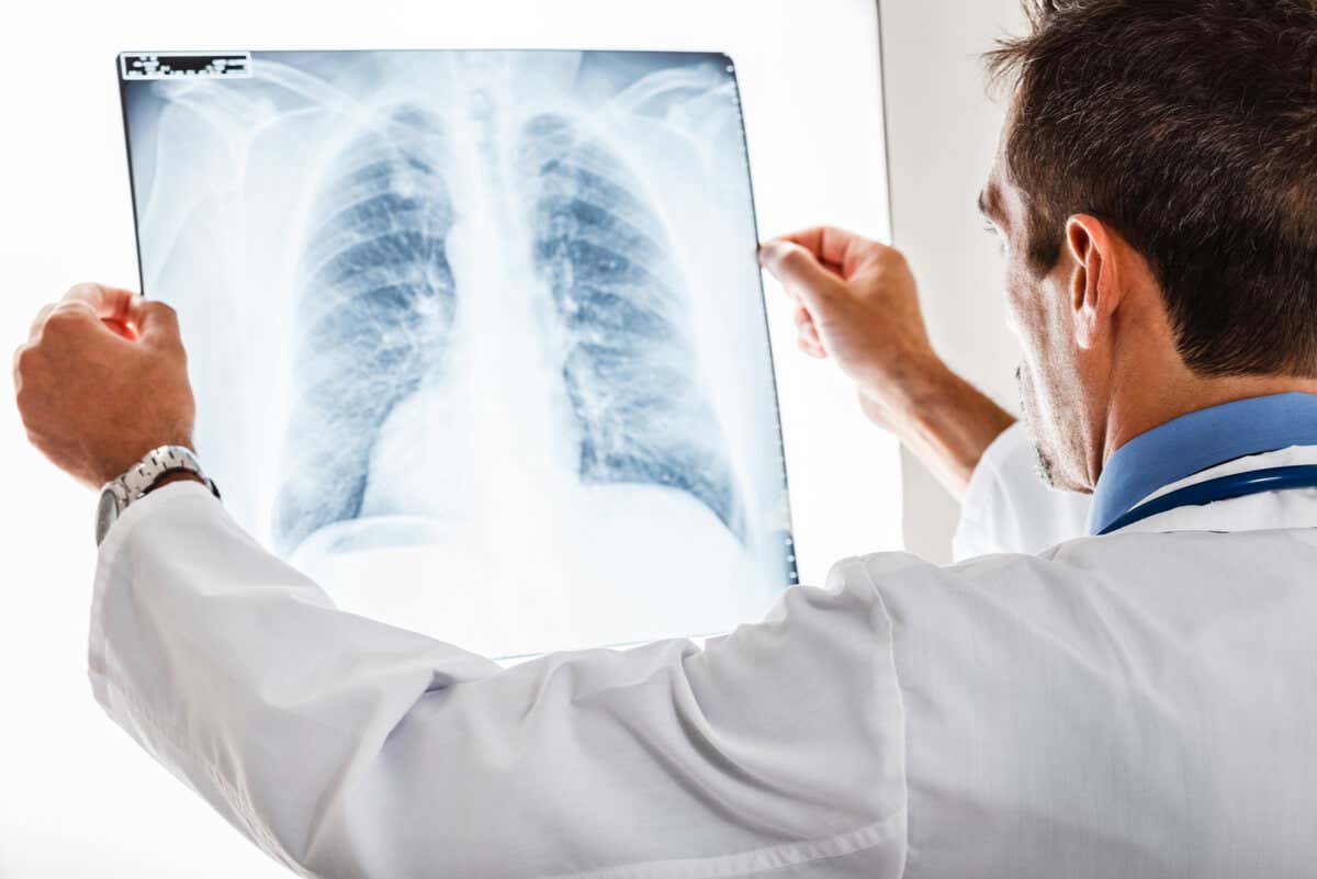 Radiografía de pulmón con bronquitis crónica.