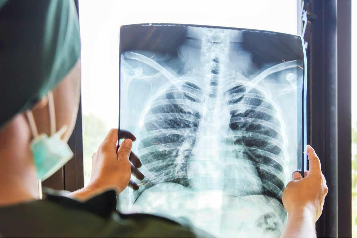 Diagnóstico de tuberculosis con radiografía.