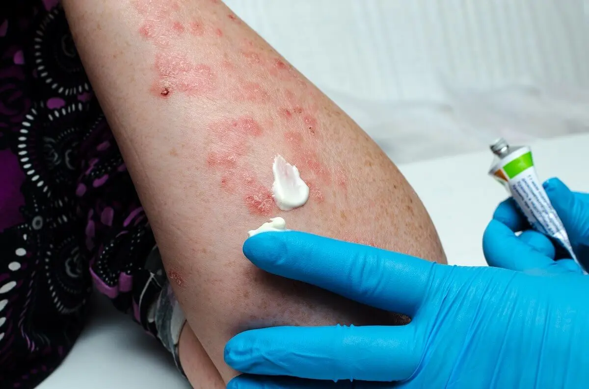 Tratamiento del herpes zóster en niños
