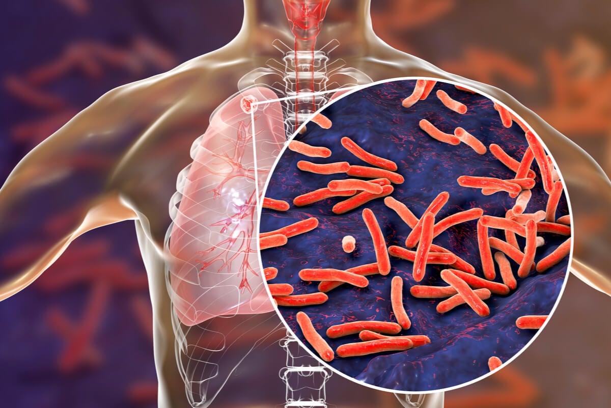 Tuberkulose causa sangre al toser.