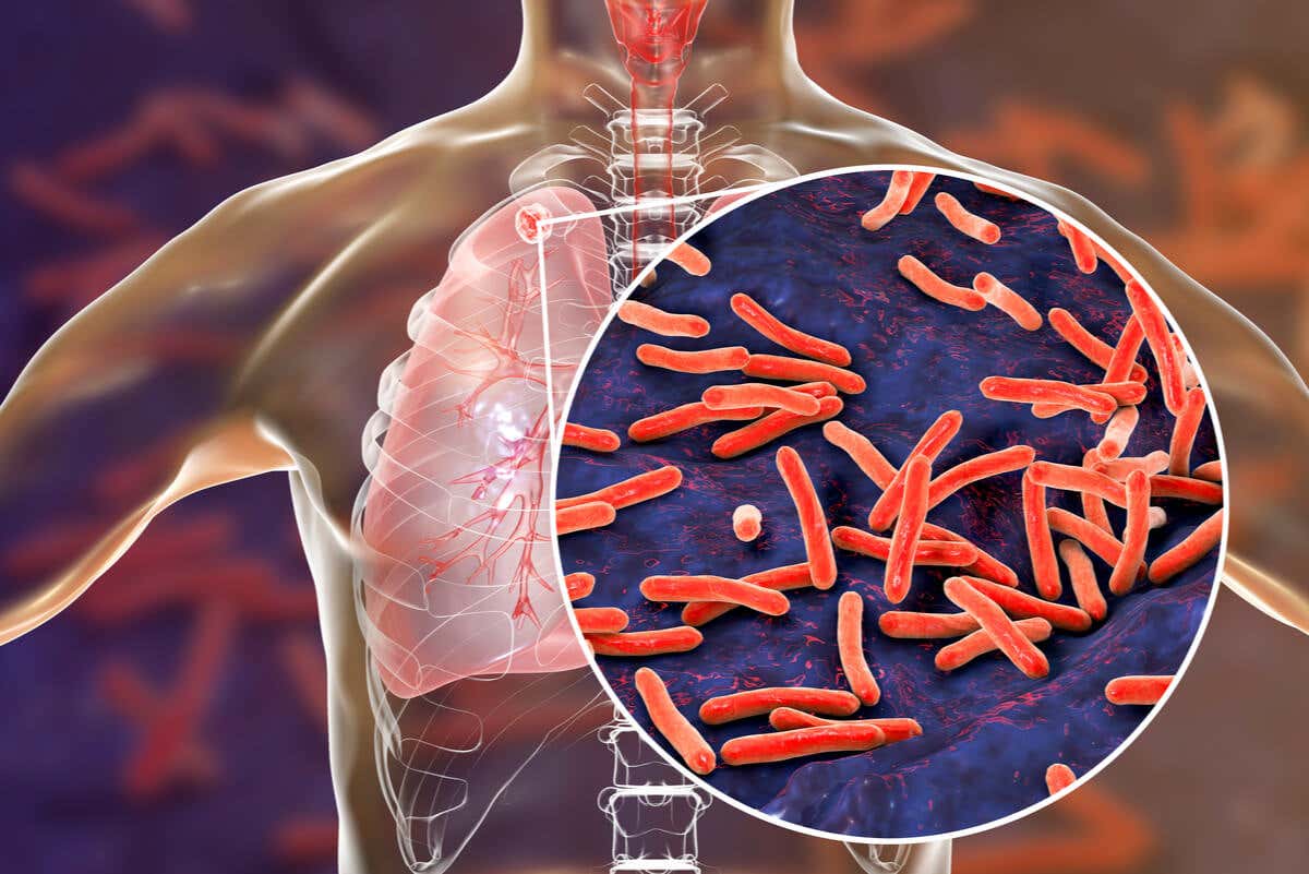 Tuberculosis causa sangre al toser.