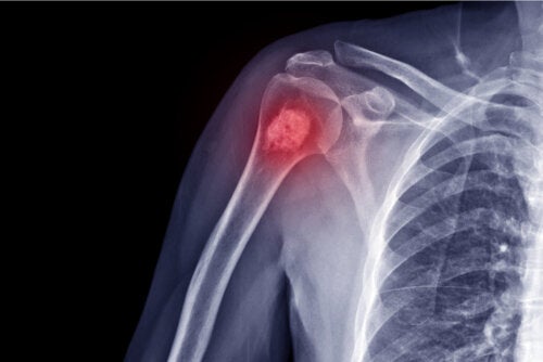 Osteosarcoma en niños: síntomas, causas y tratamiento