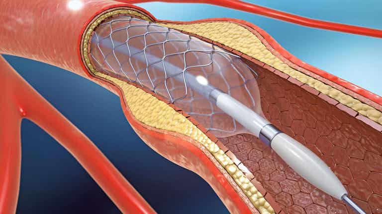 الشرايين المصابة بتصلب الشرايين.