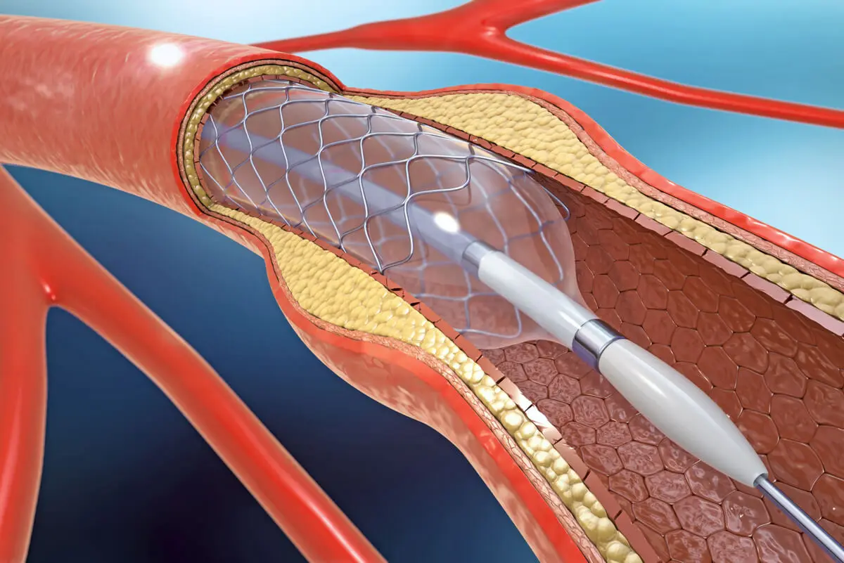 Arterias con arterioesclerosis.