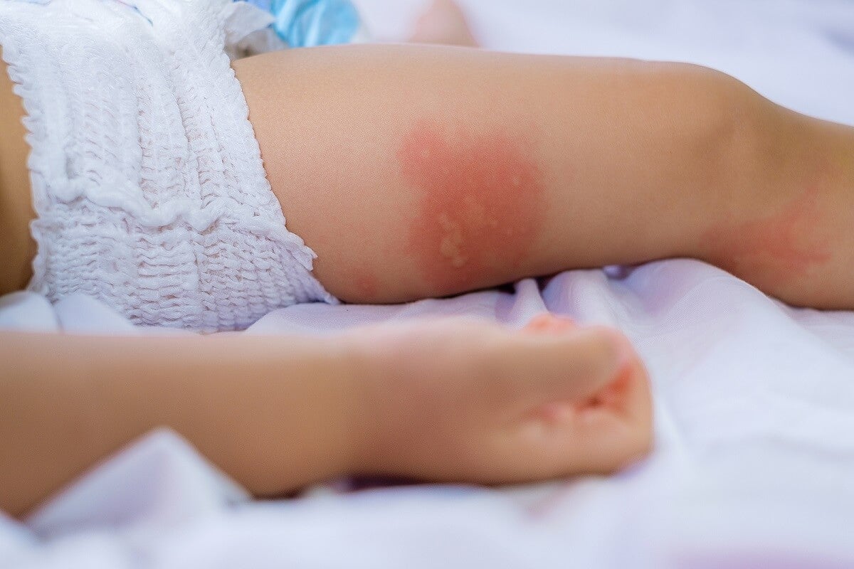 Síntomas de la dermatitis del pañal