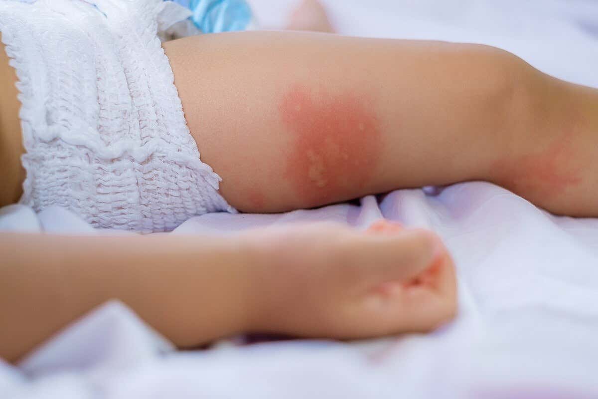 Síntomas de la dermatitis del pañal
