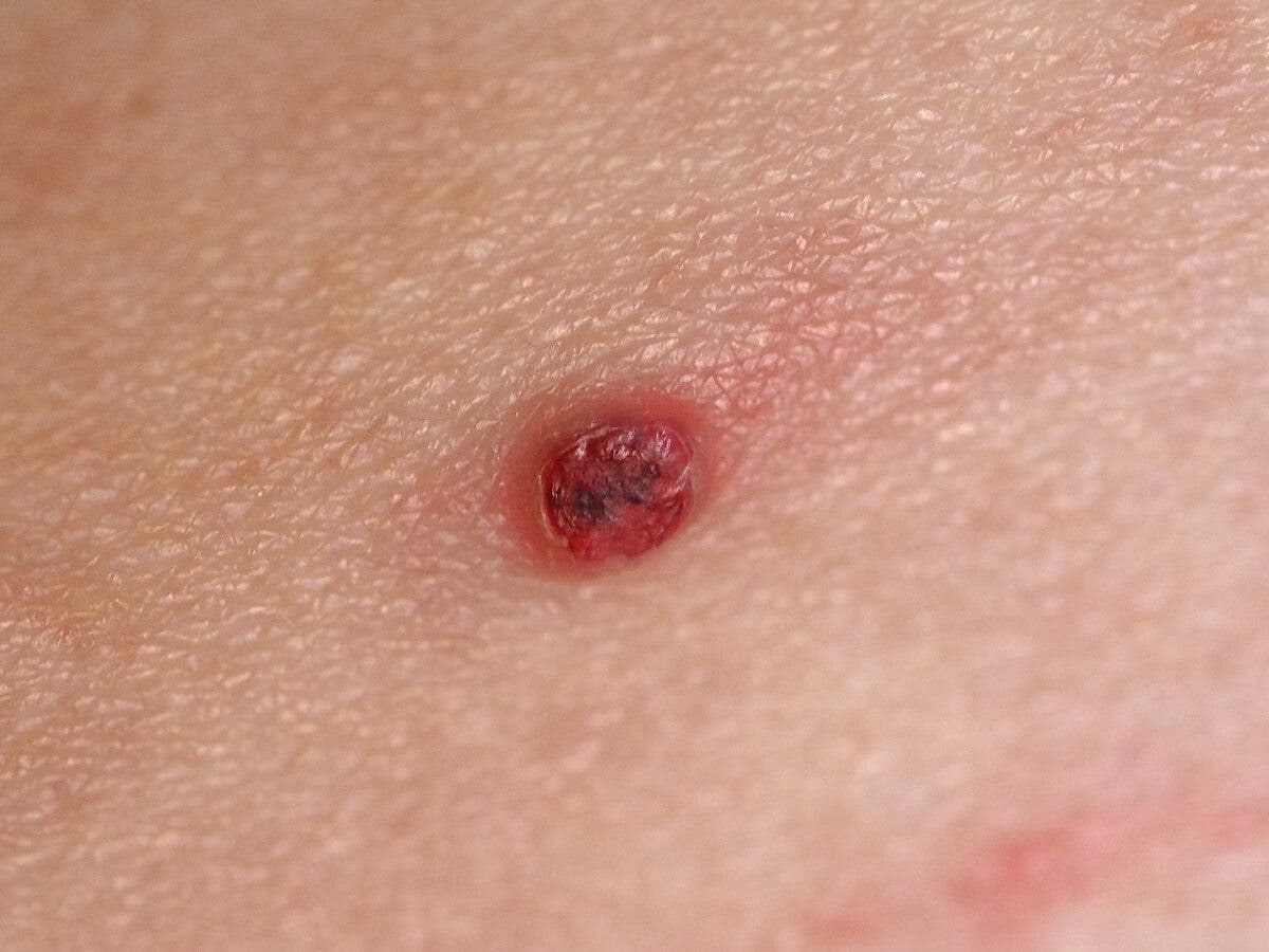 Granuloma piógeno