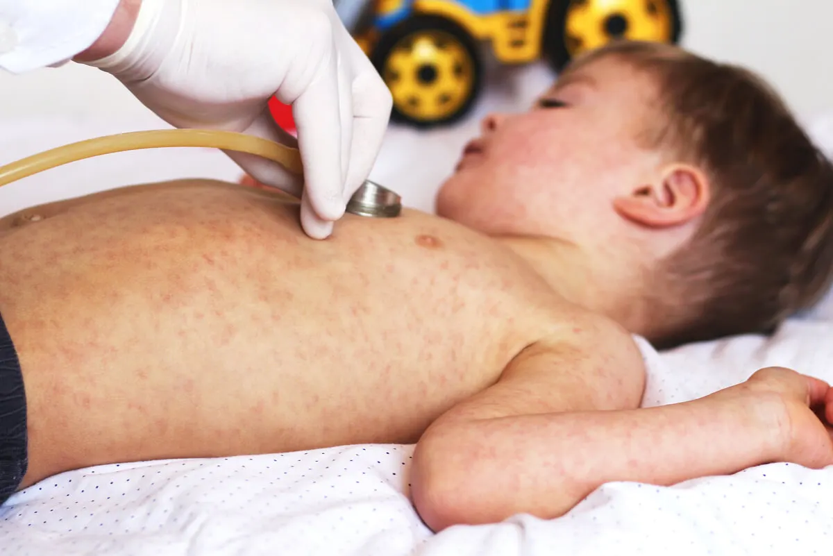 rubella vaccine