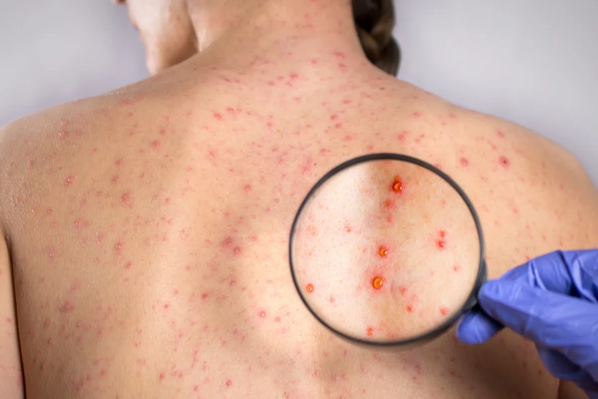 the rubella virus