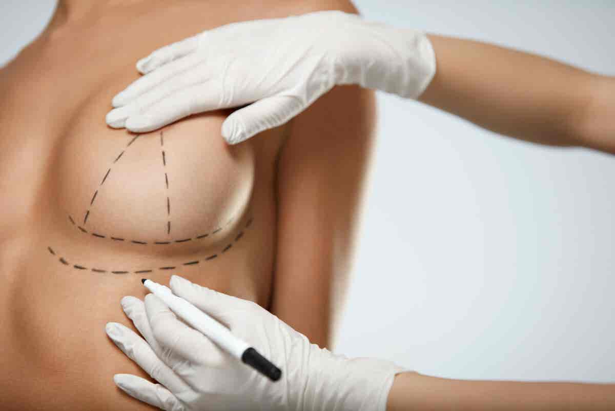 Líneas de cirugía para mastopexia.