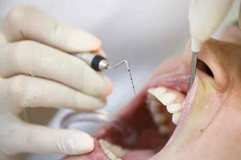 Piorrea o periodontitis: ¿qué es y cómo tratarla?