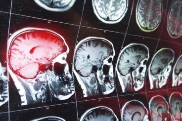 ¿Qué es la amnesia retrógrada?