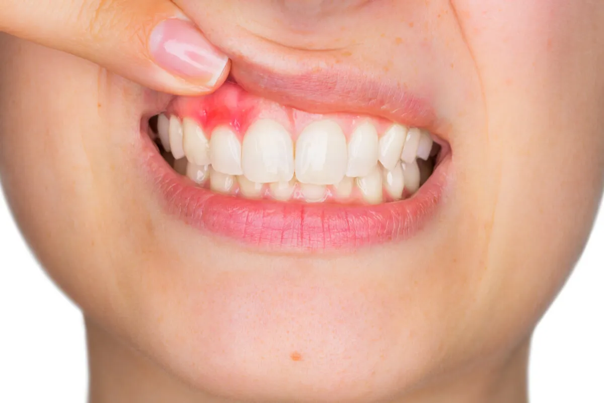 Gingivitis.