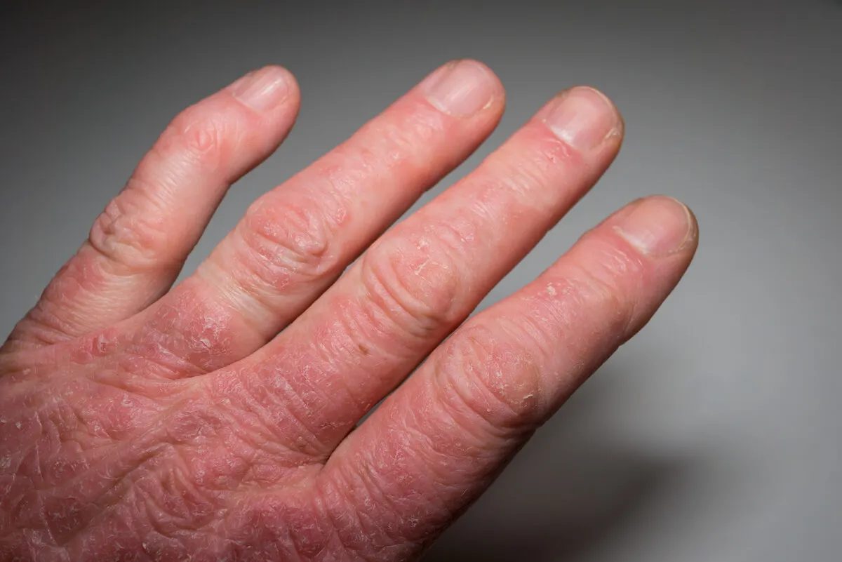 Fenómeno de Raynaud en el lupus.