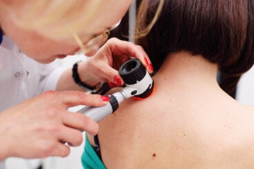 Acrocordones: causas y factores de riesgo