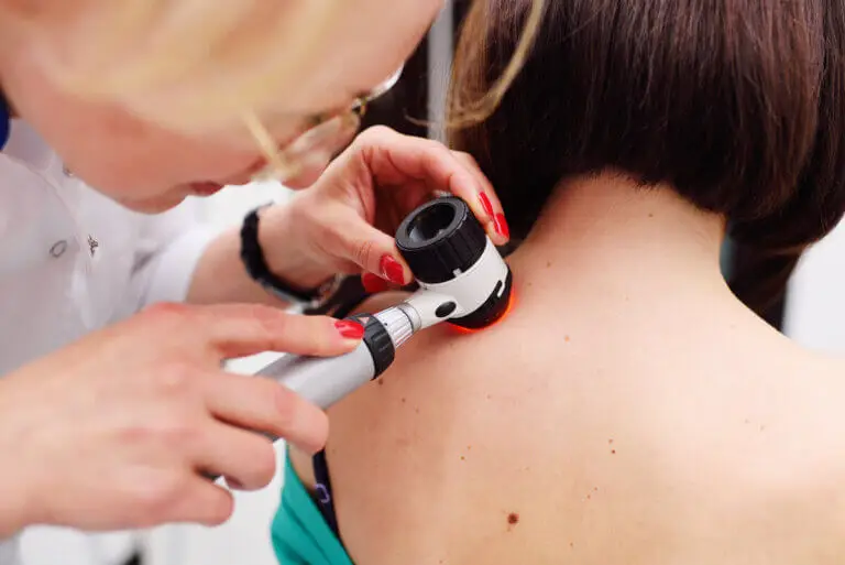 Acrocordones: causas y factores de riesgo