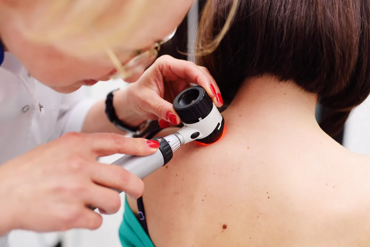 Acrocordones: causas y factores de riesgo.