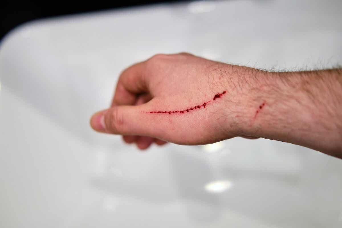 Herida que necesita sutura quirúrgica.