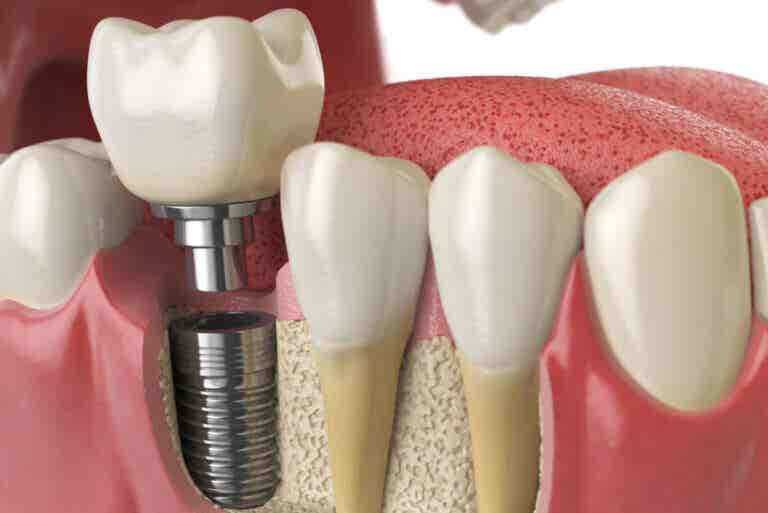 ¿Qué debes saber sobre las complicaciones de los implantes dentales?