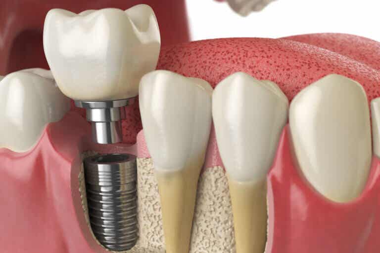¿Qué debes saber sobre las complicaciones de los implantes dentales?
