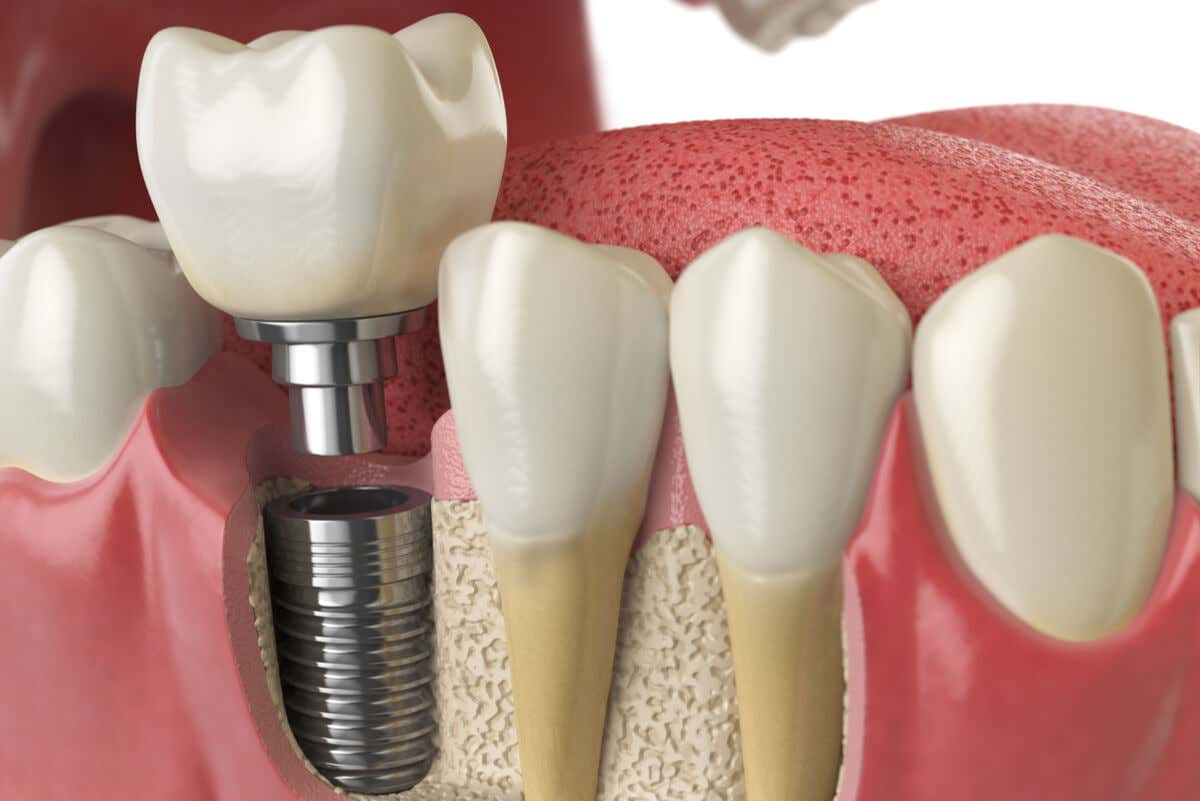 Implante dental.