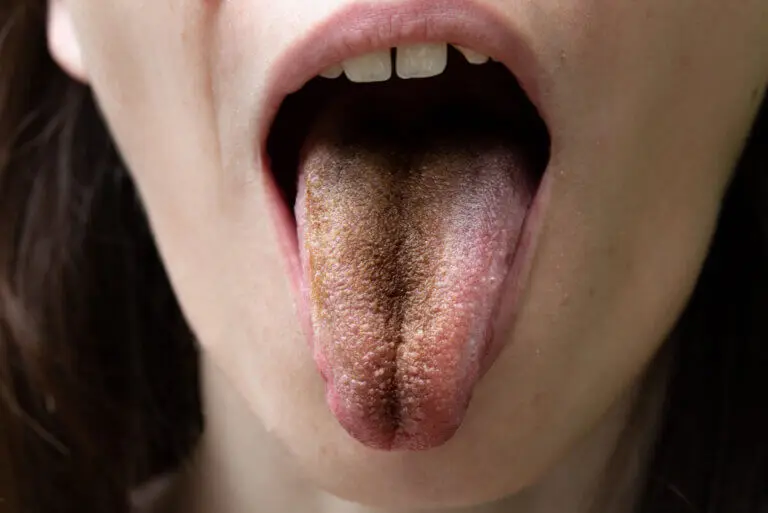 Lengua vellosa negra: causas, síntomas y consejos