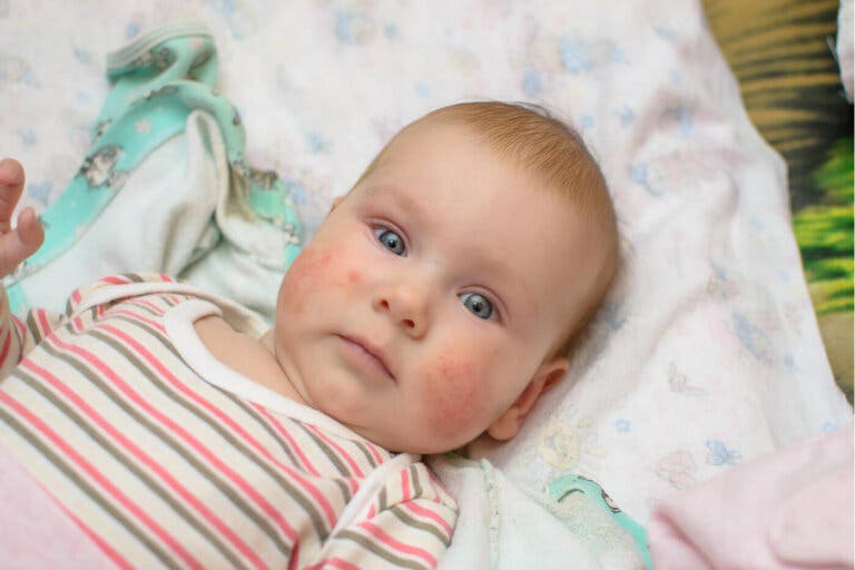¿Qué es la mastocitosis en niños?