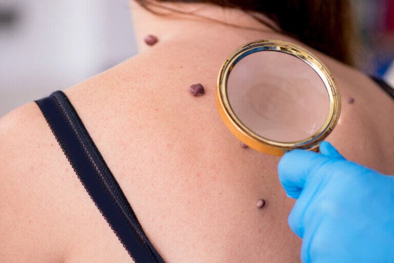 Bálsamo negro: ¿la cura contra el cáncer de piel?
