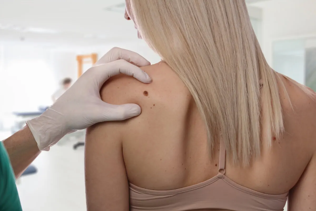 Consulta dermatológica de mujer por mancha en la piel.