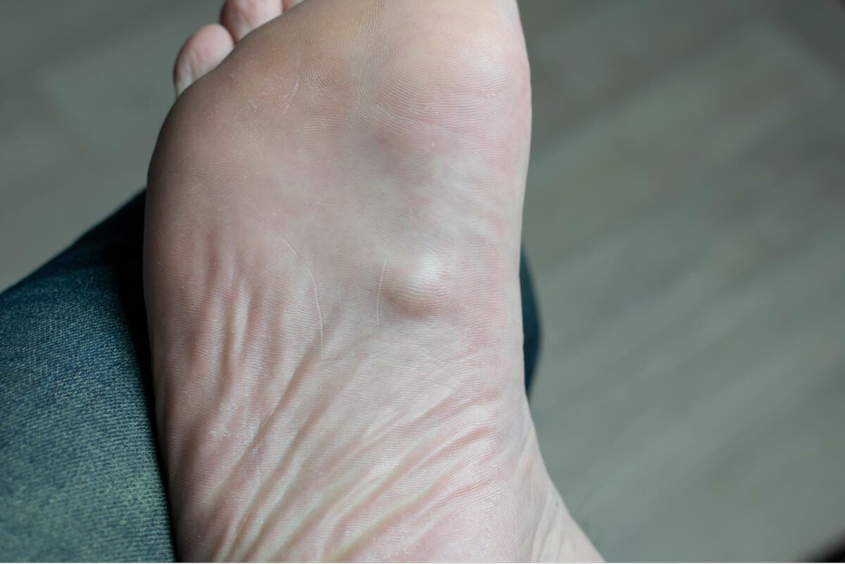 Dolor en la planta del pie.