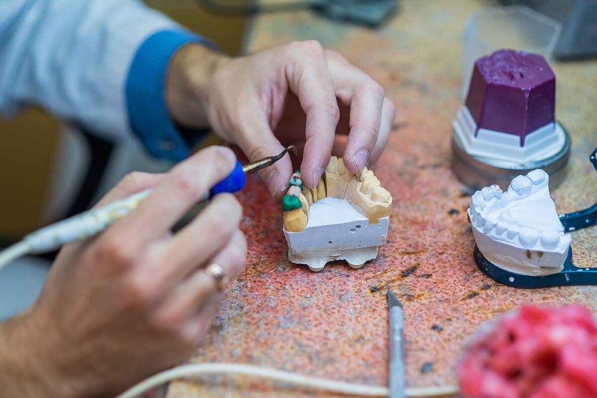 ¿Qué es un puente dental?