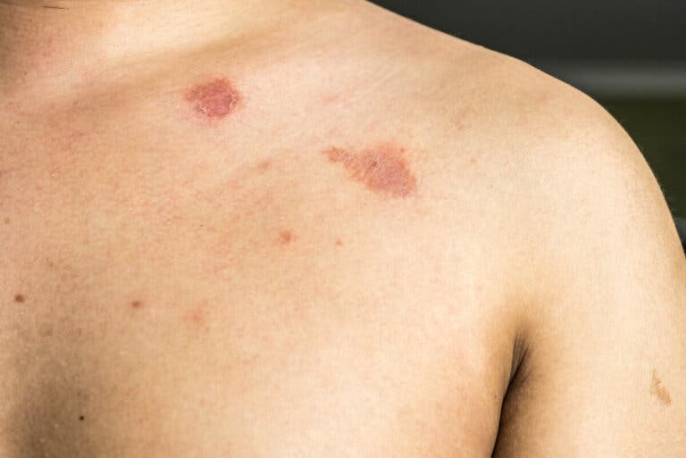 Pitiriasis versicolor: ¿en qué consiste?