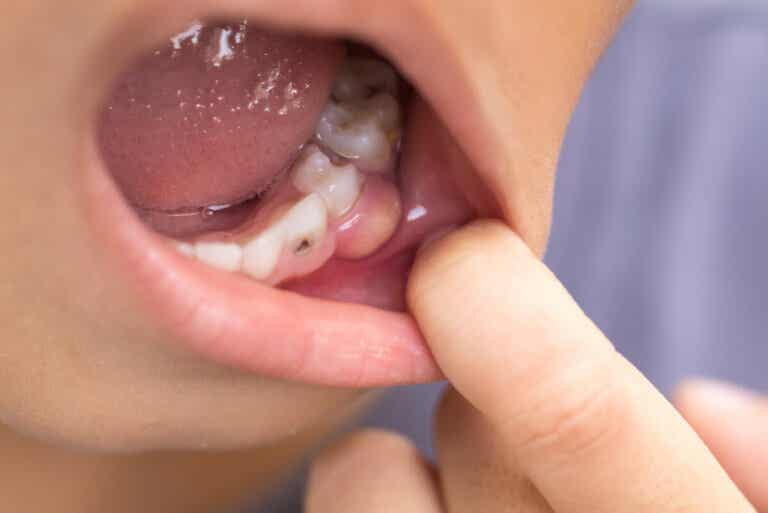 Síntomas de una infección dental que se propaga al cuerpo