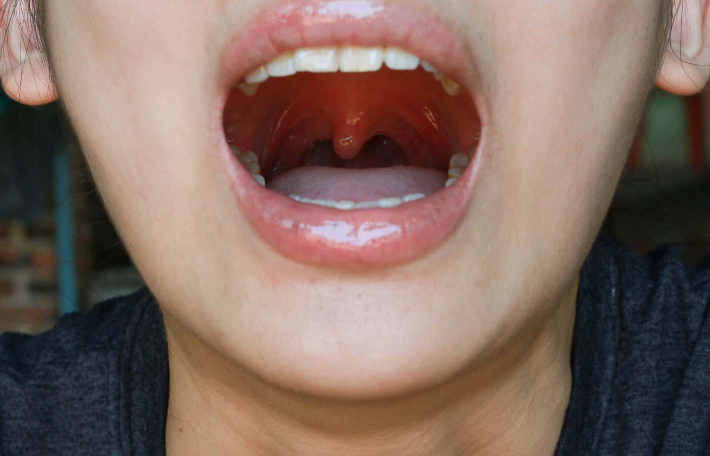 (Antonella) ¿Qué es la uvulitis y por qué puede ocurrir?