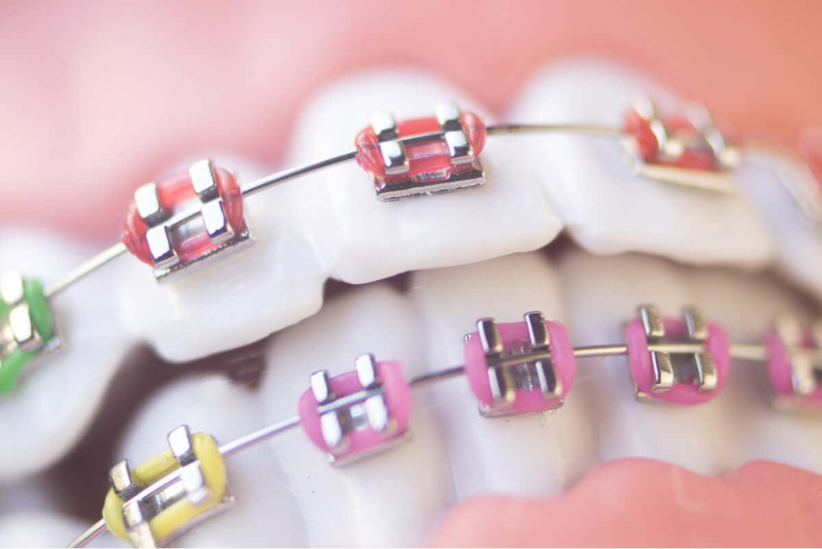Intraoralscanner - Zahnspange auf den Zähnen