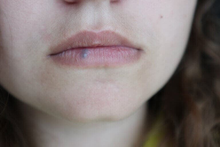 Cáncer de labio: causas, síntomas y tratamientos
