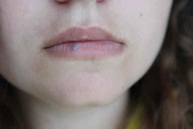 Cáncer de labio: causas, síntomas y tratamientos