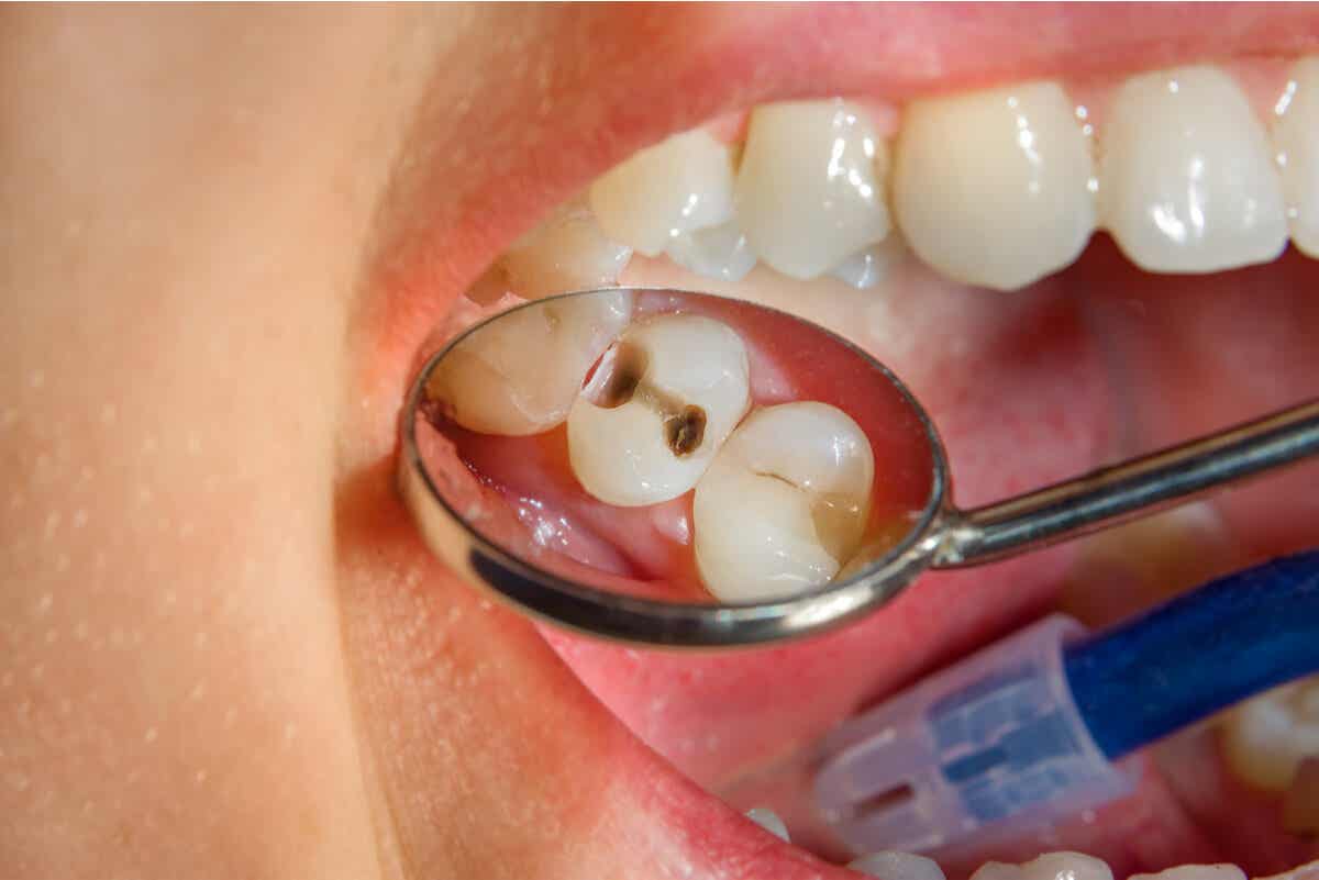 Caries dental en un niño.