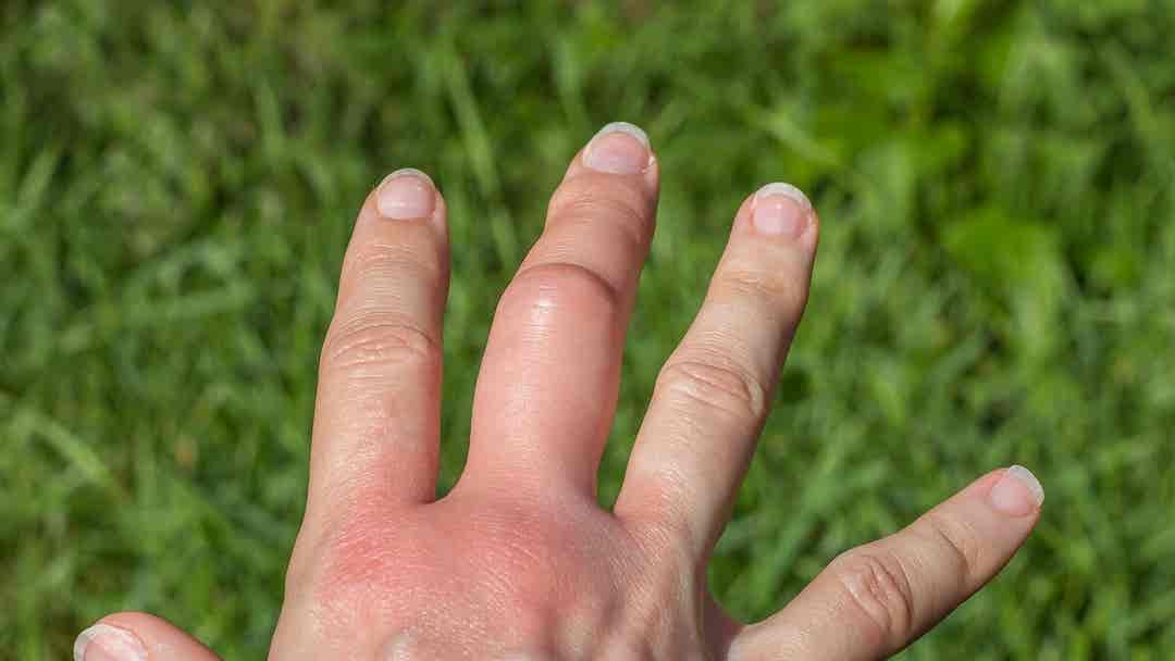 Celulitis infecciosa: causas y tratamiento - Mejor con Salud