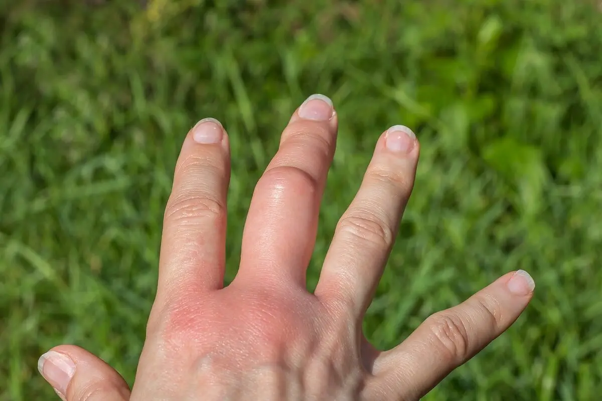 Celulitis infecciosa