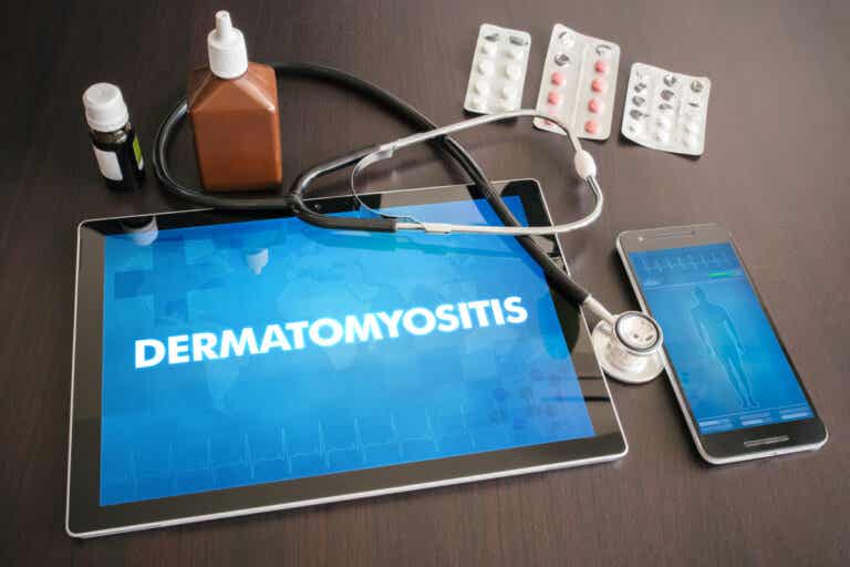 Dermatomiositis: todo lo que debes saber