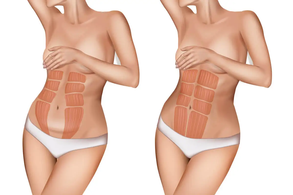 Diástasis abdominal: ¿qué es y cuáles son sus riesgos?