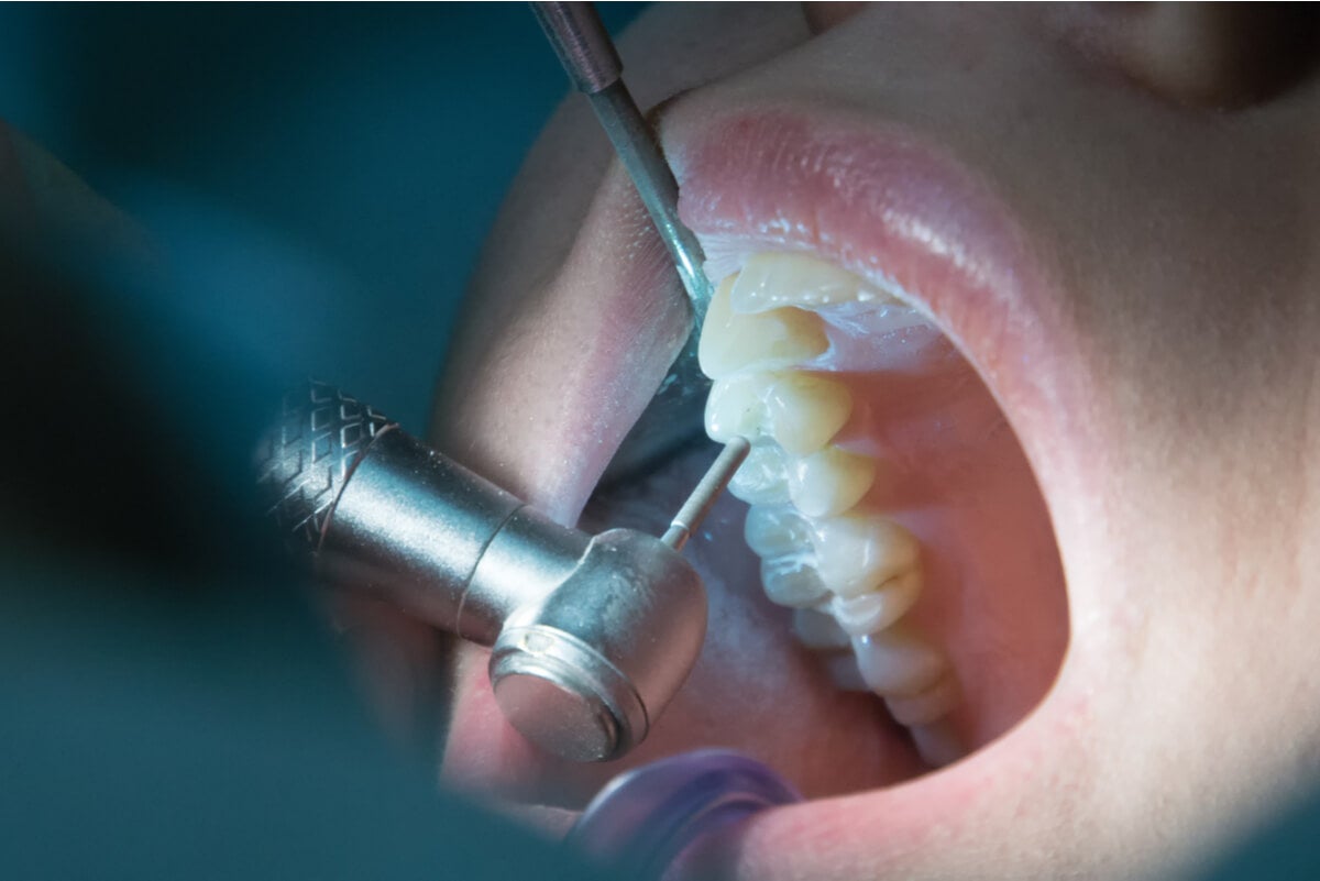 Endodoncia para tratar un diente muerto.