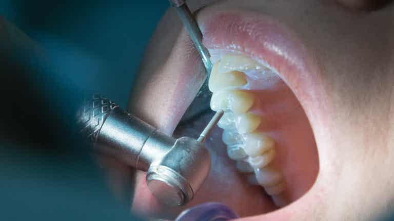 علاج جذور الأسنان لصدمات الأسنان.